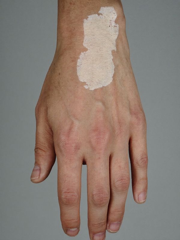 Dermatoskopi